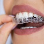VIP Invisalign Path to a Confident Smile